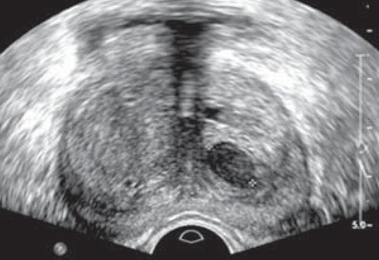 Transrectal Ultrasonography of Prostate