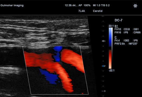 Color Doppler of Carotid Arterial System