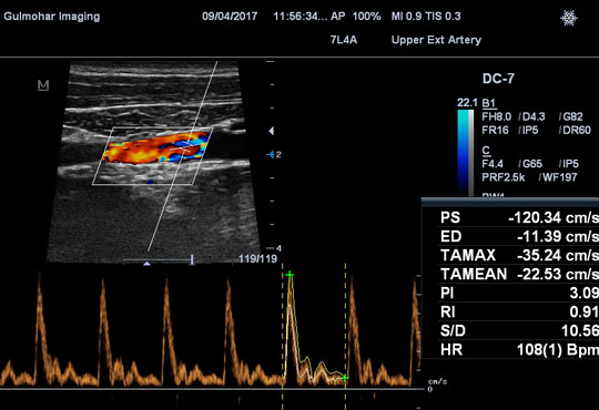 Color Doppler of Arterial system of upper and Lower Limbs